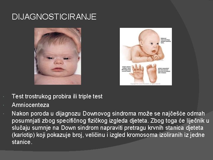 DIJAGNOSTICIRANJE Test trostrukog probira ili triple test Amniocenteza Nakon poroda u dijagnozu Downovog sindroma