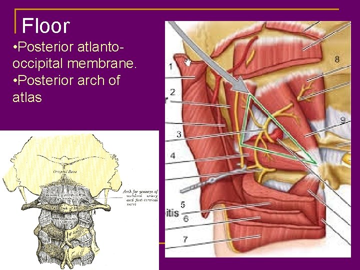 Floor • Posterior atlantooccipital membrane. • Posterior arch of atlas 