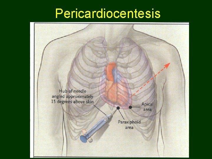 Pericardiocentesis 