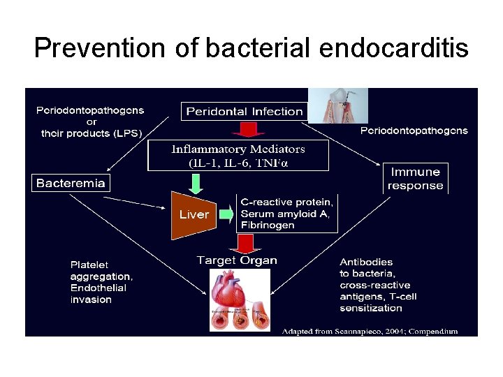 Prevention of bacterial endocarditis 