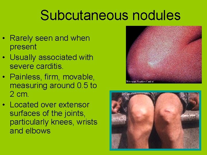 Subcutaneous nodules • Rarely seen and when present • Usually associated with severe carditis.