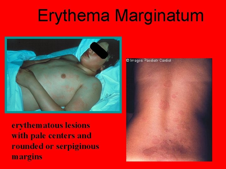 Erythema Marginatum erythematous lesions with pale centers and rounded or serpiginous margins 