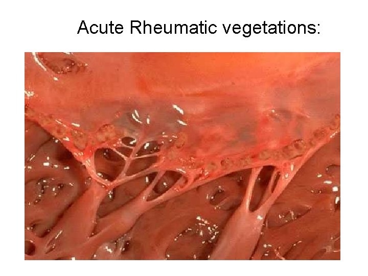 Acute Rheumatic vegetations: 