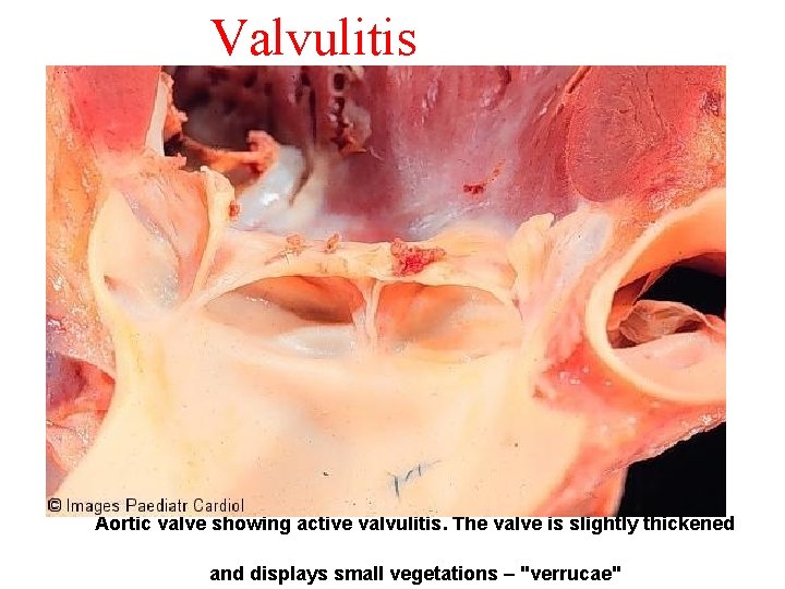 Valvulitis Aortic valve showing active valvulitis. The valve is slightly thickened and displays small
