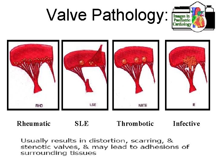 Valve Pathology: Rheumatic SLE Thrombotic Infective 