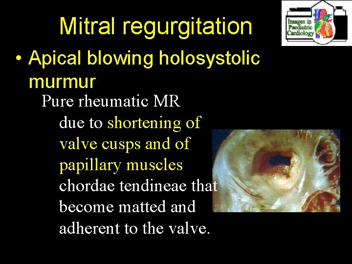 Mitral regurgitation • Apical blowing holosystolic murmur Pure rheumatic MR due to shortening of