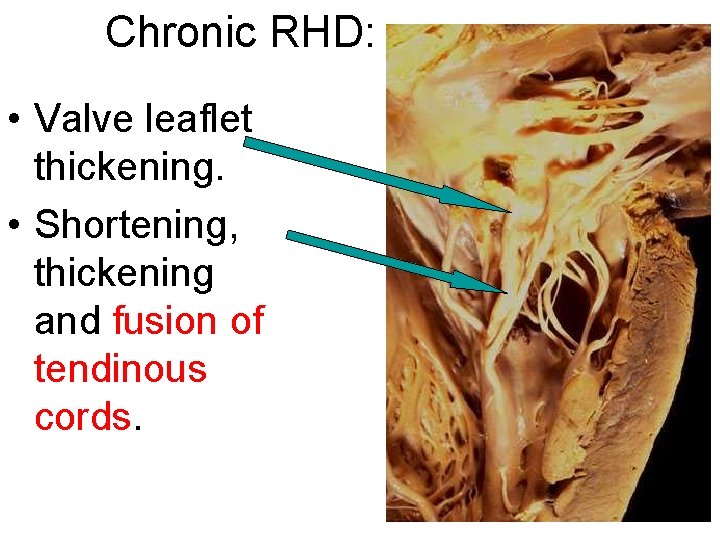 Chronic RHD: • Valve leaflet thickening. • Shortening, thickening and fusion of tendinous cords.