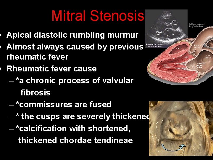 Mitral Stenosis • Apical diastolic rumbling murmur • Almost always caused by previous rheumatic