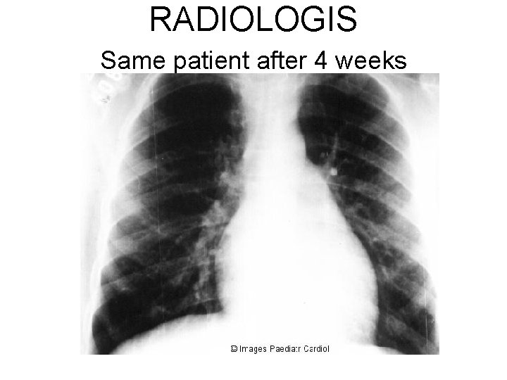 RADIOLOGIS Same patient after 4 weeks 