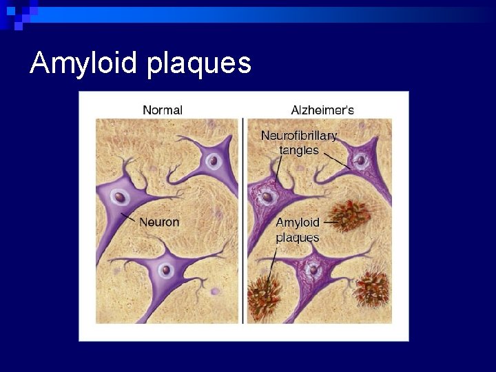 Amyloid plaques 