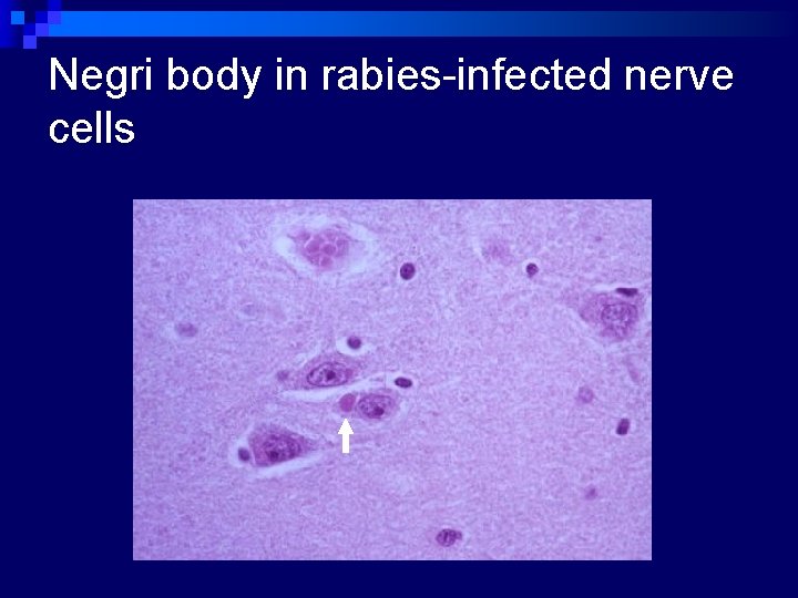 Negri body in rabies-infected nerve cells 