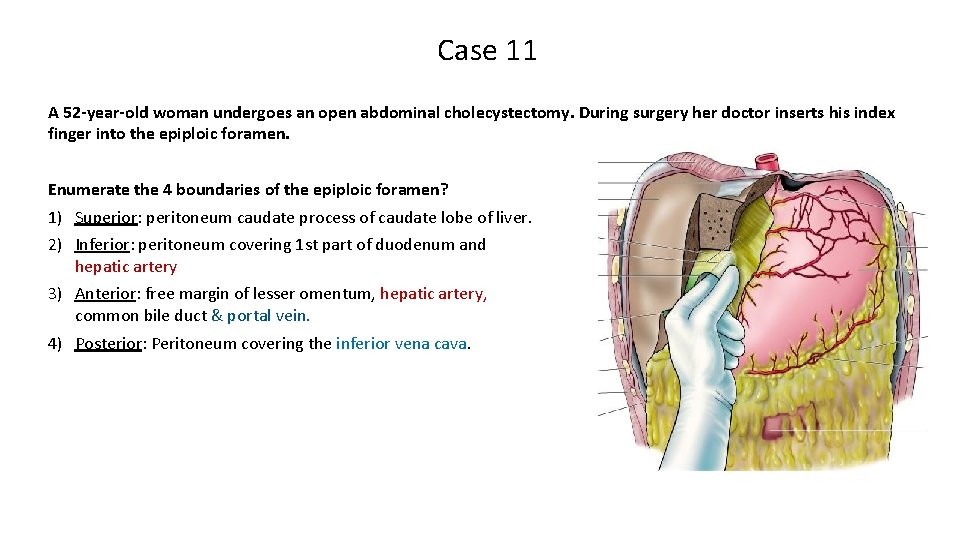 Case 11 A 52 -year-old woman undergoes an open abdominal cholecystectomy. During surgery her