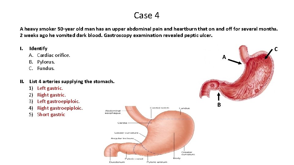 Case 4 A heavy smoker 50 -year old man has an upper abdominal pain