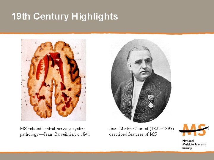 19 th Century Highlights MS-related central nervous system pathology—Jean Cruveilhier, c 1841 Jean-Martin Charcot