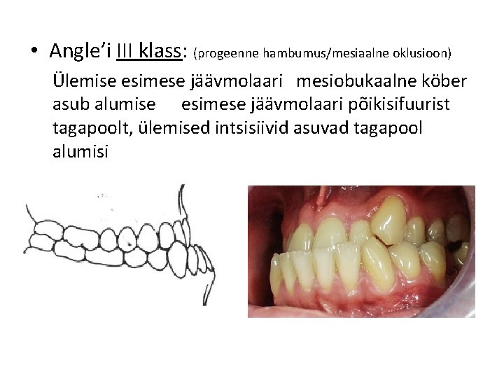  • Angle’i III klass: (progeenne hambumus/mesiaalne oklusioon) Ülemise esimese jäävmolaari mesiobukaalne köber asub