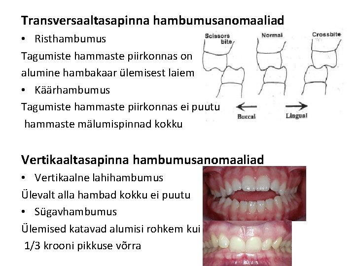 Transversaaltasapinna hambumusanomaaliad • Risthambumus Tagumiste hammaste piirkonnas on alumine hambakaar ülemisest laiem • Käärhambumus