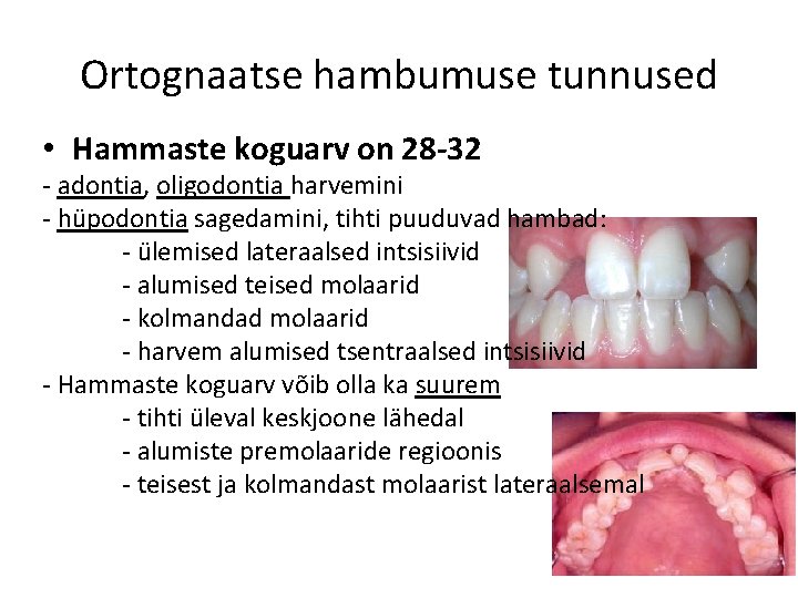 Ortognaatse hambumuse tunnused • Hammaste koguarv on 28 -32 - adontia, oligodontia harvemini -