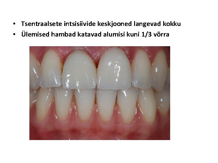  • Tsentraalsete intsisiivide keskjooned langevad kokku • Ülemised hambad katavad alumisi kuni 1/3