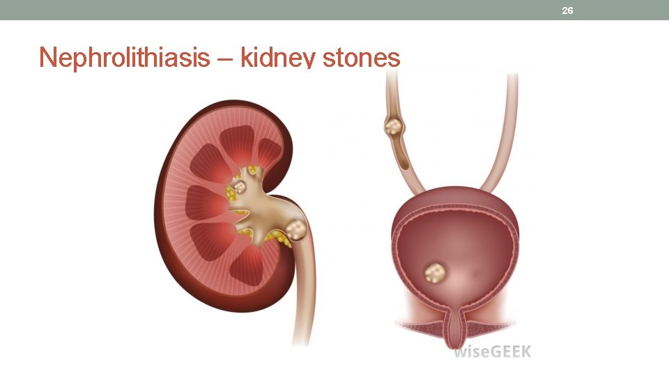 26 Nephrolithiasis – kidney stones 