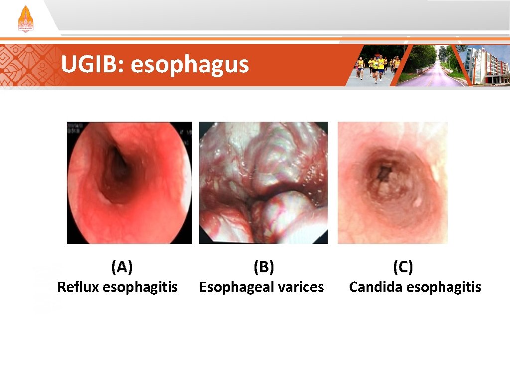 UGIB: esophagus (A) Reflux esophagitis (B) Esophageal varices (C) Candida esophagitis UGIB: esophagus (A) Reflux esophagitis (B) Esophageal varices (C) Candida esophagitis