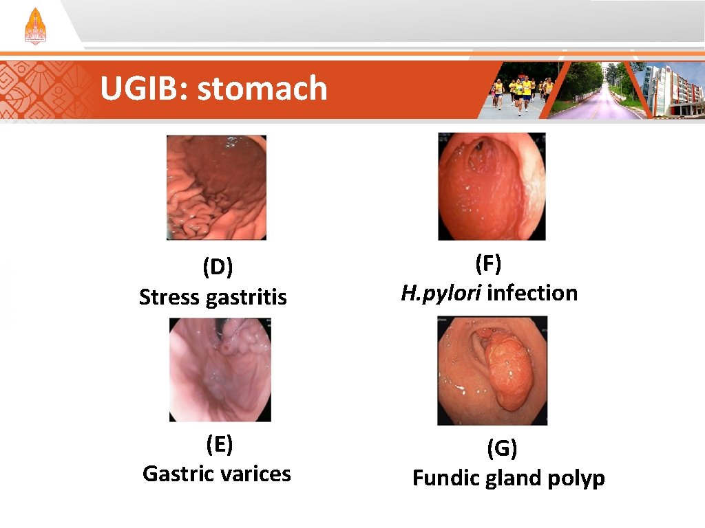 UGIB: stomach (D) Stress gastritis (E) Gastric varices (F) H. pylori infection (G) Fundic UGIB: stomach (D) Stress gastritis (E) Gastric varices (F) H. pylori infection (G) Fundic