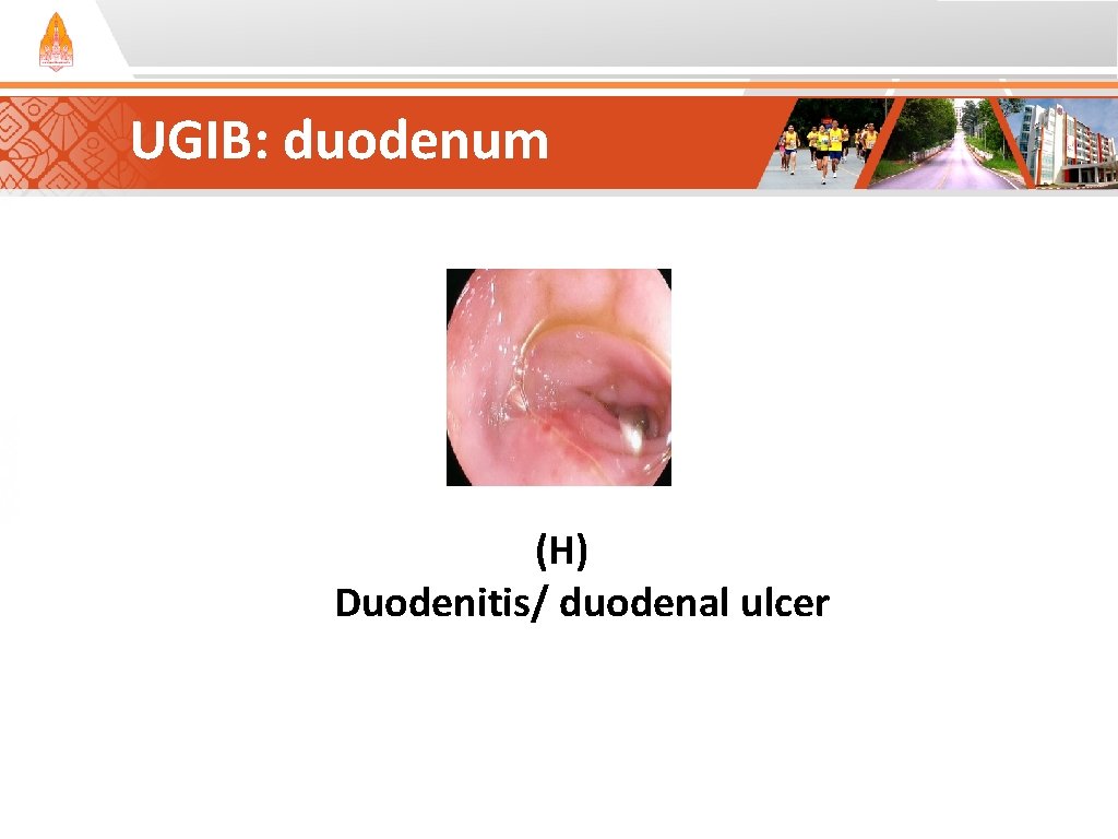 UGIB: duodenum (H) Duodenitis/ duodenal ulcer UGIB: duodenum (H) Duodenitis/ duodenal ulcer