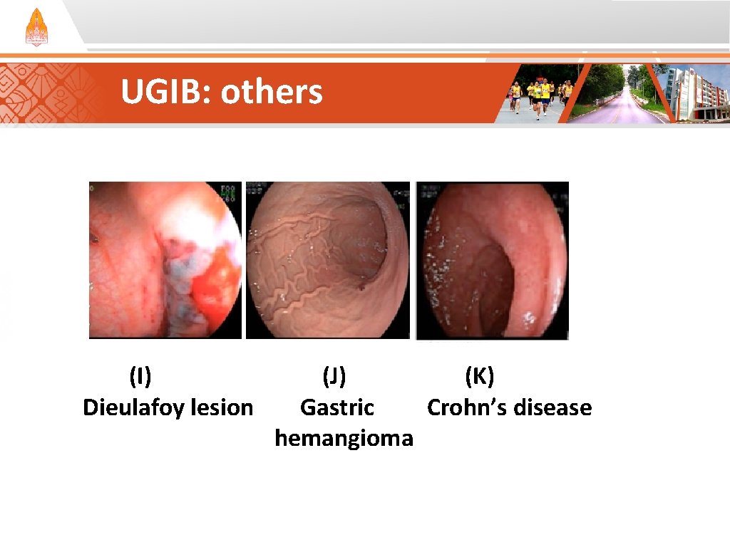 UGIB: others (I) Dieulafoy lesion (J) (K) Gastric Crohn’s disease hemangioma UGIB: others (I) Dieulafoy lesion (J) (K) Gastric Crohn’s disease hemangioma