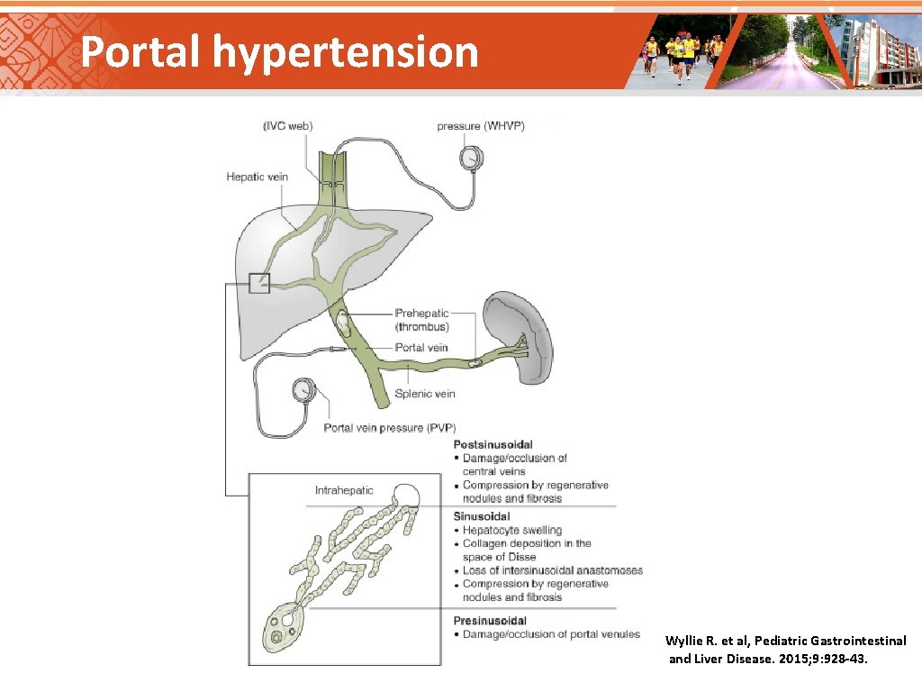 Portal hypertension Wyllie R. et al, Pediatric Gastrointestinal and Liver Disease. 2015; 9: 928 Portal hypertension Wyllie R. et al, Pediatric Gastrointestinal and Liver Disease. 2015; 9: 928