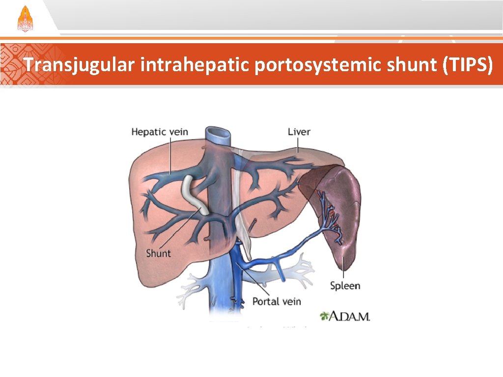 Transjugular intrahepatic portosystemic shunt (TIPS) Transjugular intrahepatic portosystemic shunt (TIPS)