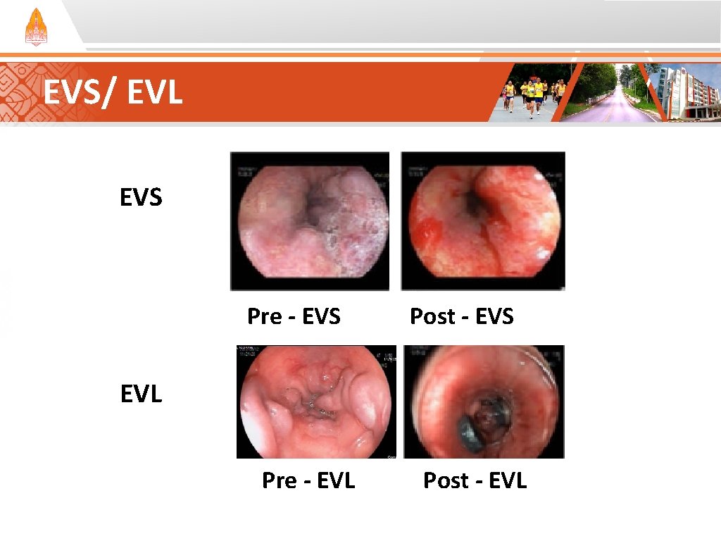 EVS/ EVL EVS Pre - EVS Post - EVS EVL Pre - EVL Post EVS/ EVL EVS Pre - EVS Post - EVS EVL Pre - EVL Post