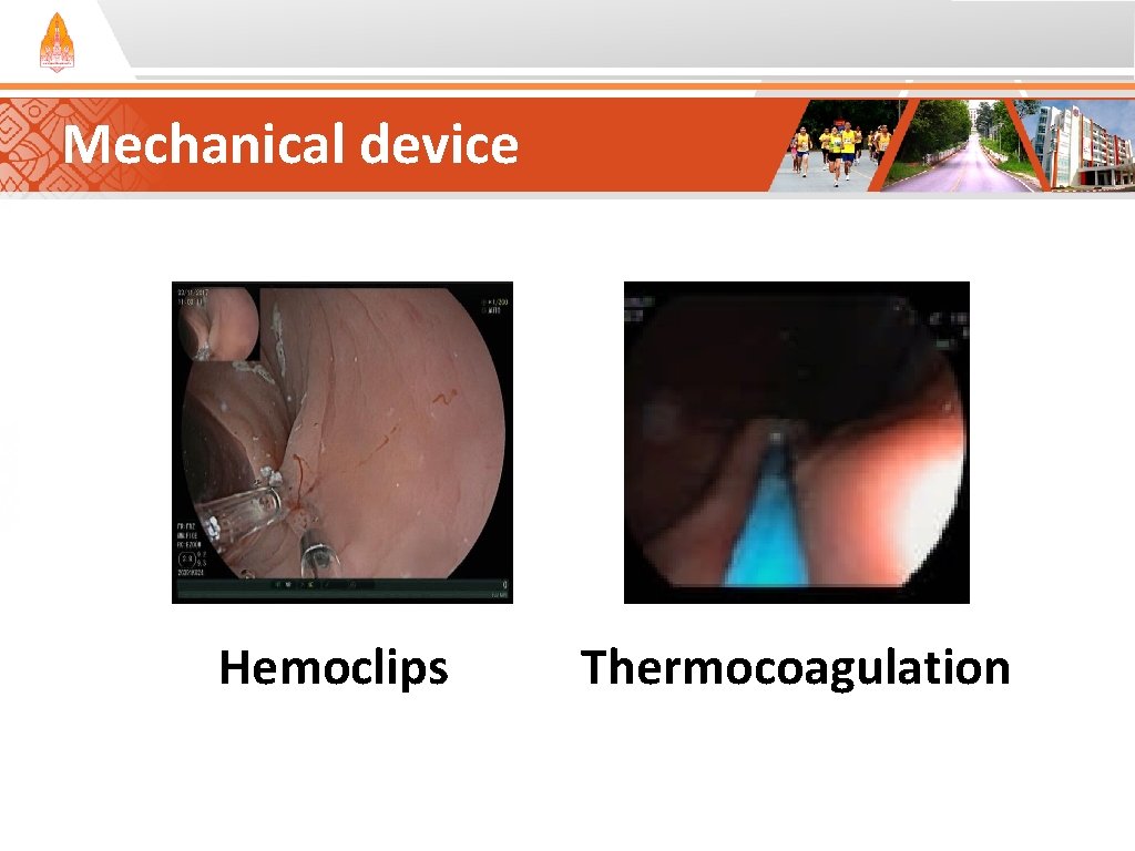 Mechanical device Hemoclips Thermocoagulation Mechanical device Hemoclips Thermocoagulation
