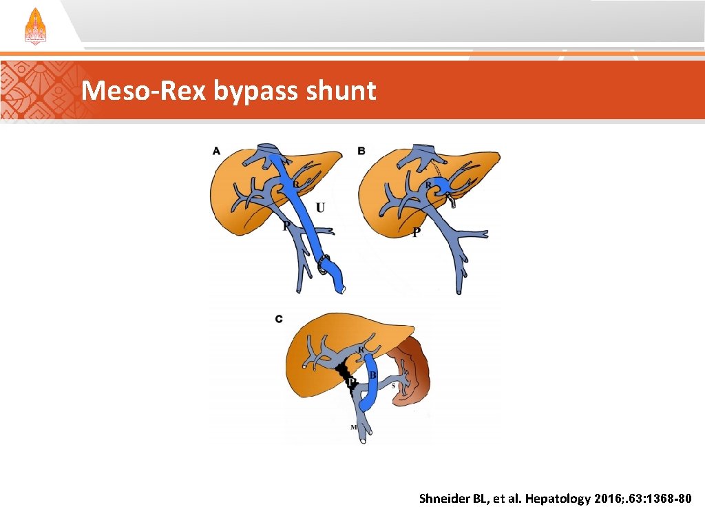 Meso-Rex bypass shunt Shneider BL, et al. Hepatology 2016; . 63: 1368 -80 Meso-Rex bypass shunt Shneider BL, et al. Hepatology 2016; . 63: 1368 -80