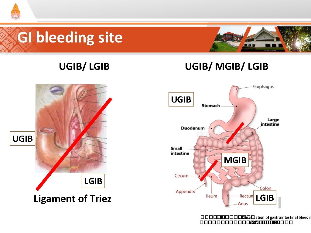 GI bleeding site UGIB/ LGIB UGIB/ MGIB/ LGIB UGIB MGIB Ligament of Triez LGIB GI bleeding site UGIB/ LGIB UGIB/ MGIB/ LGIB UGIB MGIB Ligament of Triez LGIB