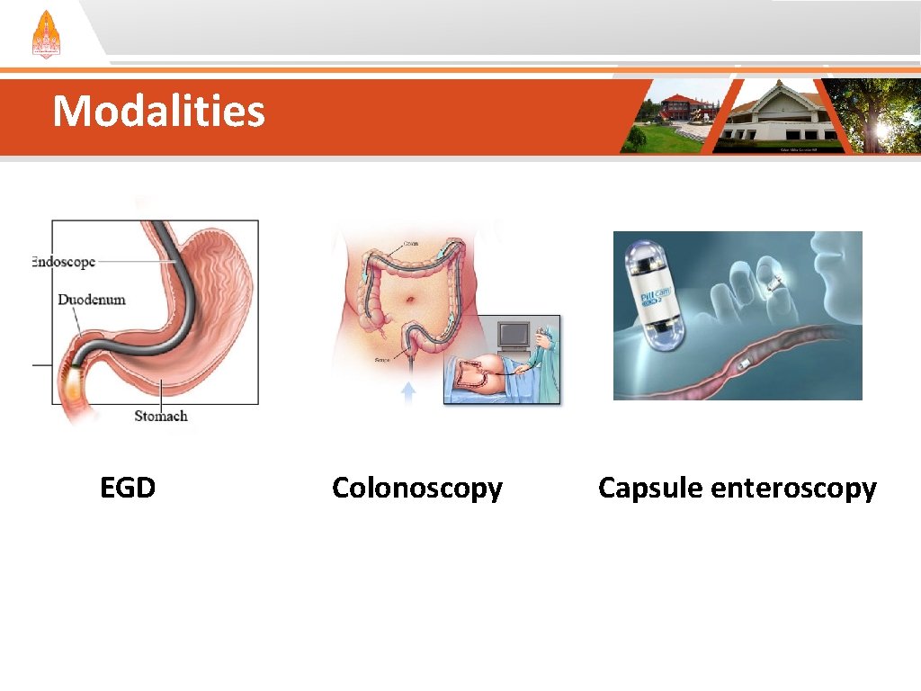 Modalities EGD Colonoscopy Capsule enteroscopy Modalities EGD Colonoscopy Capsule enteroscopy