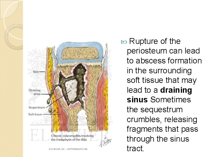  Rupture of the periosteum can lead to abscess formation in the surrounding soft