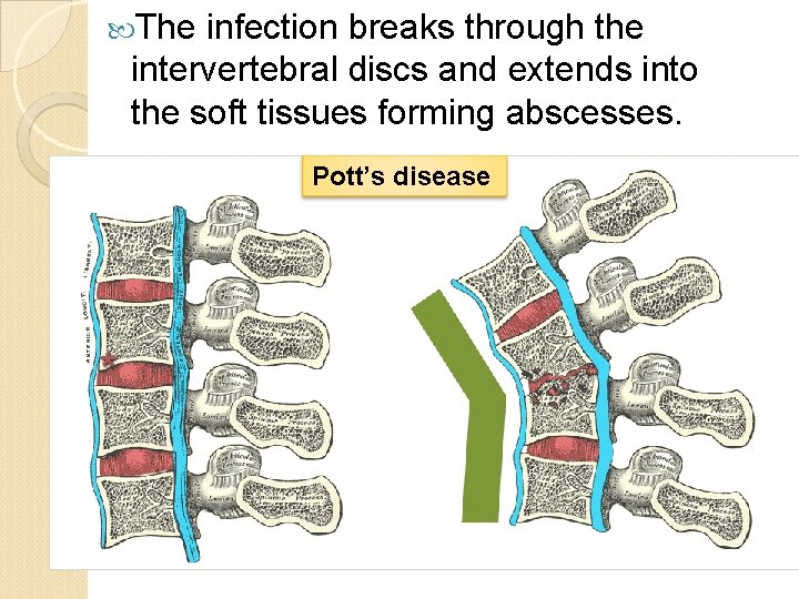  The infection breaks through the intervertebral discs and extends into the soft tissues