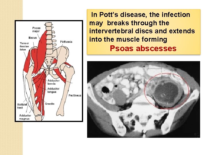  In Pott’s disease, the infection may breaks through the intervertebral discs and extends