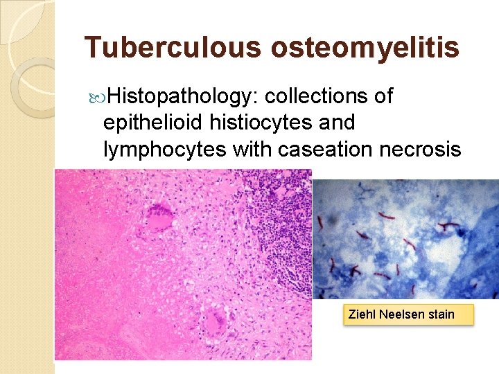 Tuberculous osteomyelitis Histopathology: collections of epithelioid histiocytes and lymphocytes with caseation necrosis Ziehl Neelsen