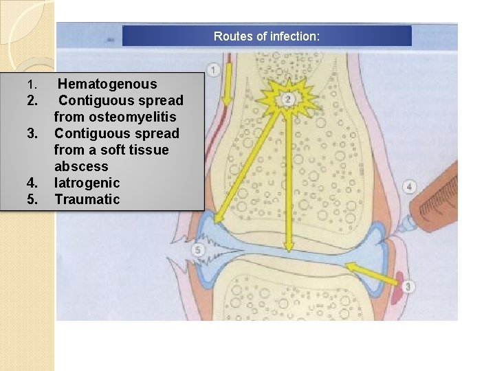 Routes of infection: 1. Hematogenous 2. Contiguous spread from osteomyelitis Contiguous spread from a