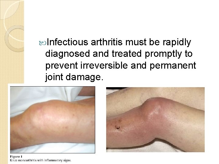  Infectious arthritis must be rapidly diagnosed and treated promptly to prevent irreversible and