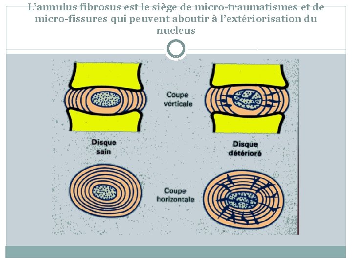 L’annulus fibrosus est le siège de micro-traumatismes et de micro-fissures qui peuvent aboutir à