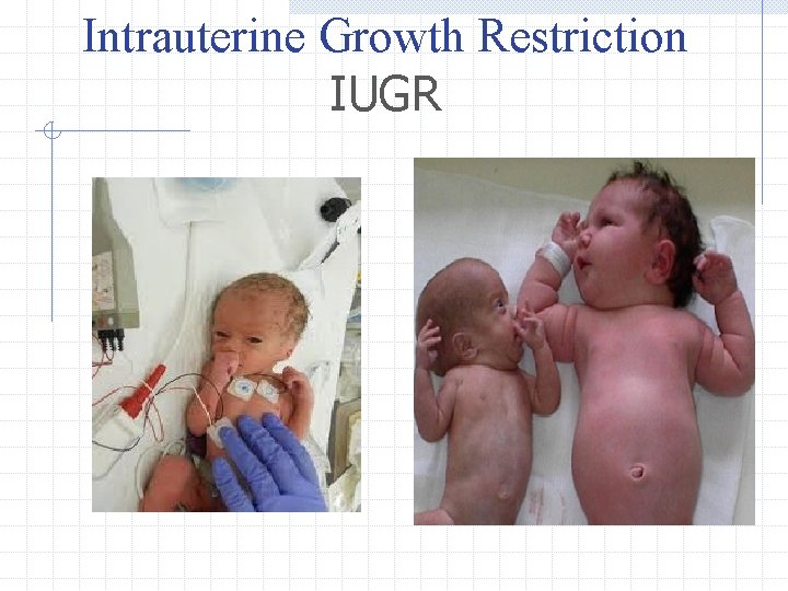 Intrauterine Growth Restriction IUGR 