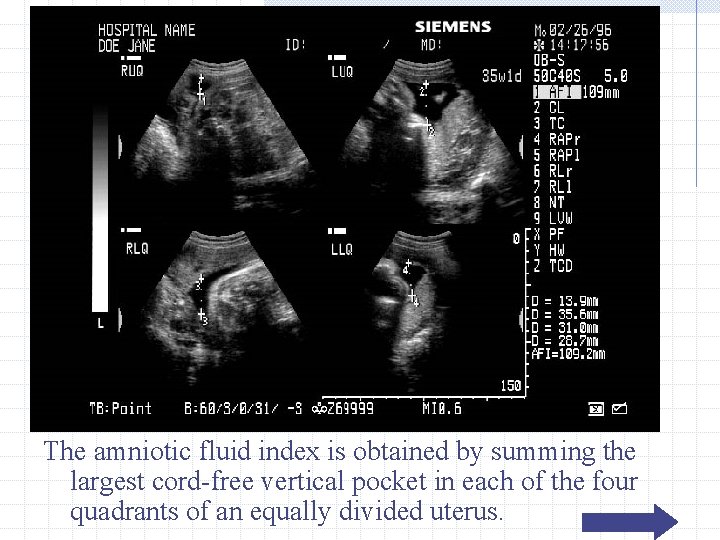 The amniotic fluid index is obtained by summing the largest cord-free vertical pocket in