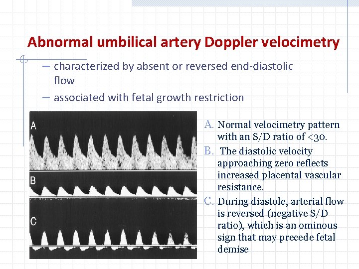 Abnormal umbilical artery Doppler velocimetry – characterized by absent or reversed end-diastolic flow –
