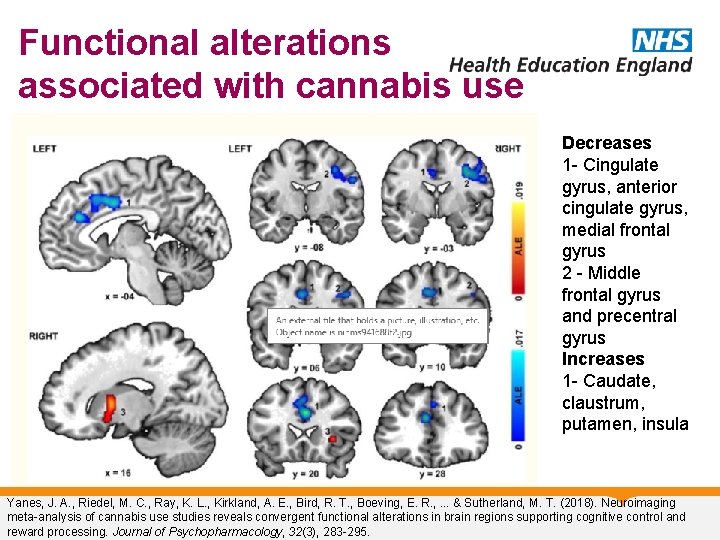 Functional alterations associated with cannabis use Decreases 1 - Cingulate gyrus, anterior cingulate gyrus,