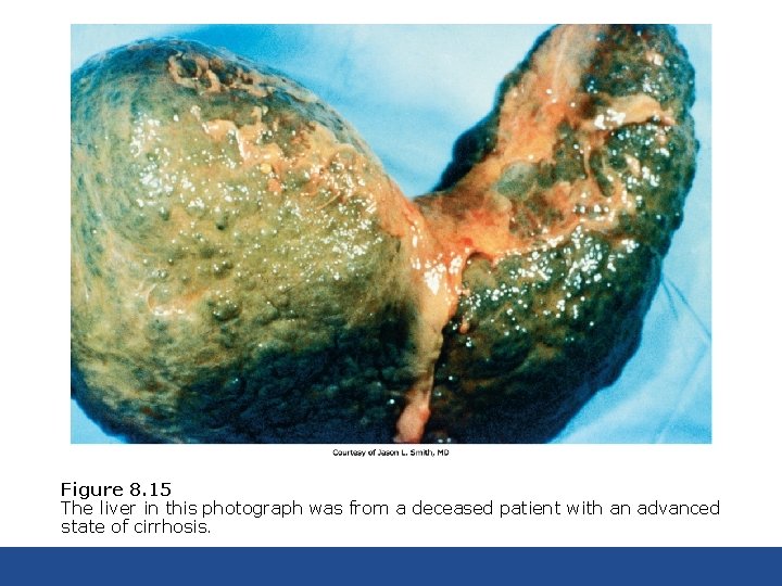 Figure 8. 15 The liver in this photograph was from a deceased patient with