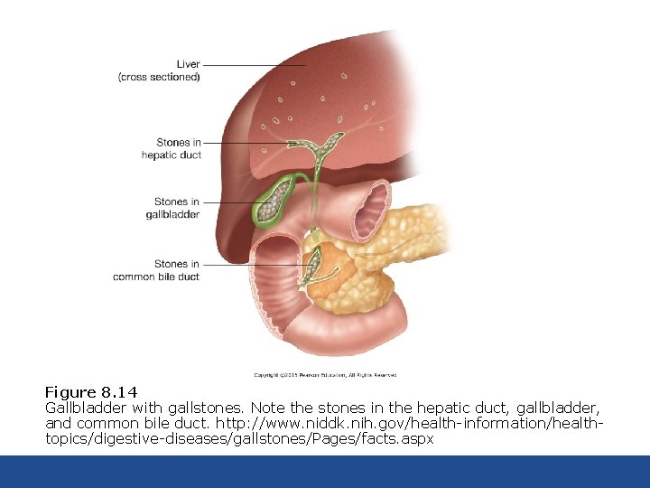 Figure 8. 14 Gallbladder with gallstones. Note the stones in the hepatic duct, gallbladder,