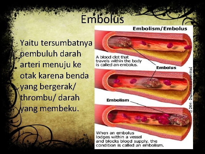 Embolus Yaitu tersumbatnya pembuluh darah arteri menuju ke otak karena benda yang bergerak/ thrombu/