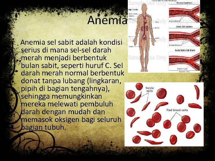 Anemia sel sabit adalah kondisi serius di mana sel-sel darah menjadi berbentuk bulan sabit,