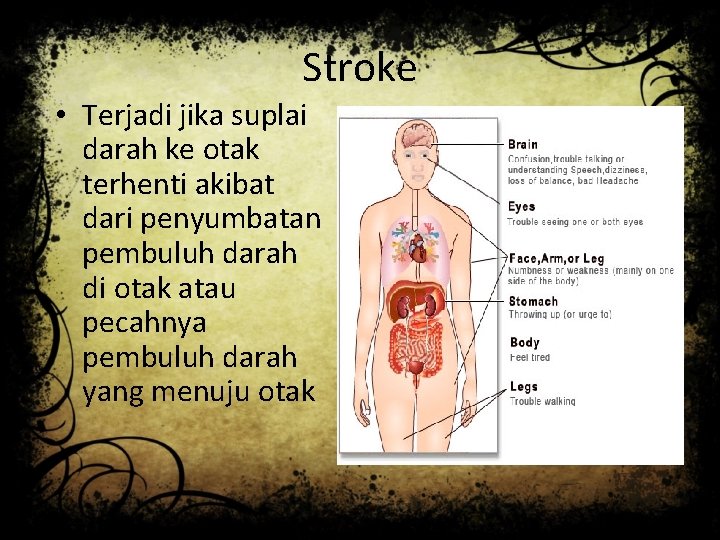 Stroke • Terjadi jika suplai darah ke otak terhenti akibat dari penyumbatan pembuluh darah